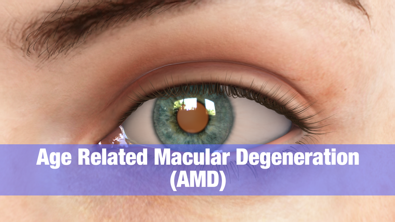 Age related Macular Degeneration Dry form. Macular Degeneration картинки глаз.